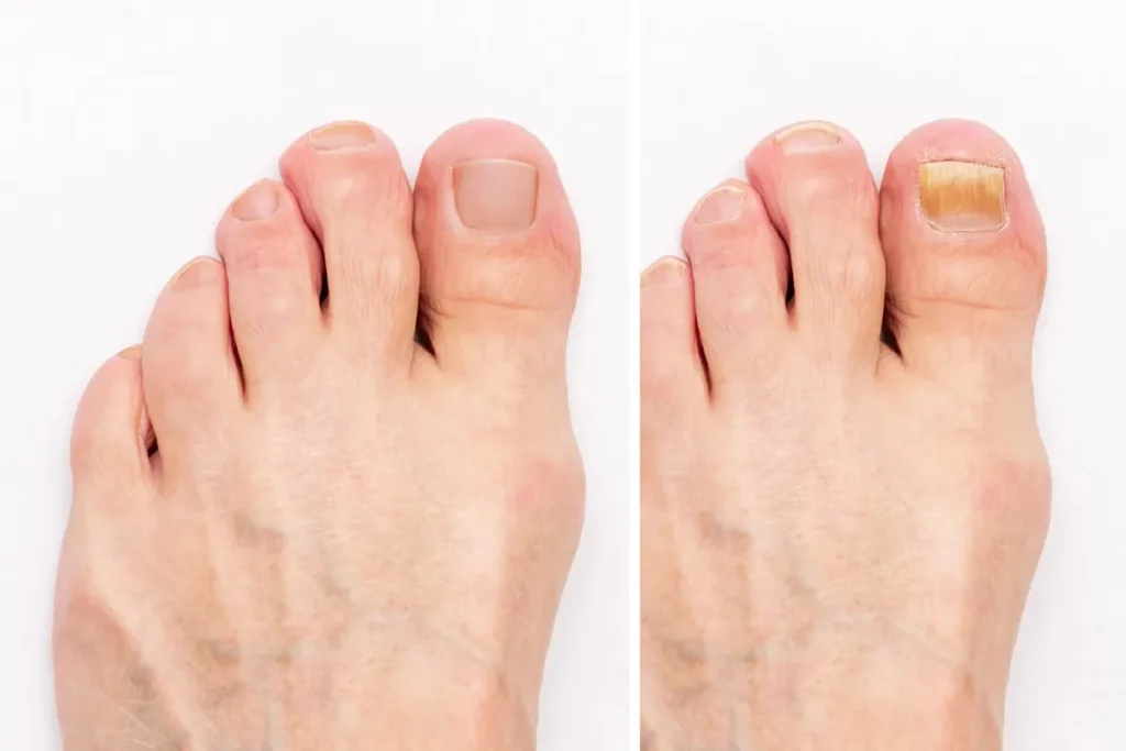 laserbehandling för nagelsvamp