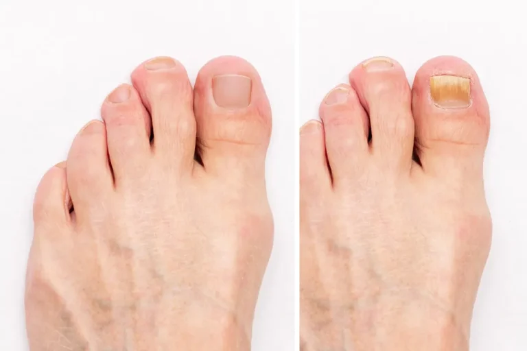 laserbehandling för nagelsvamp