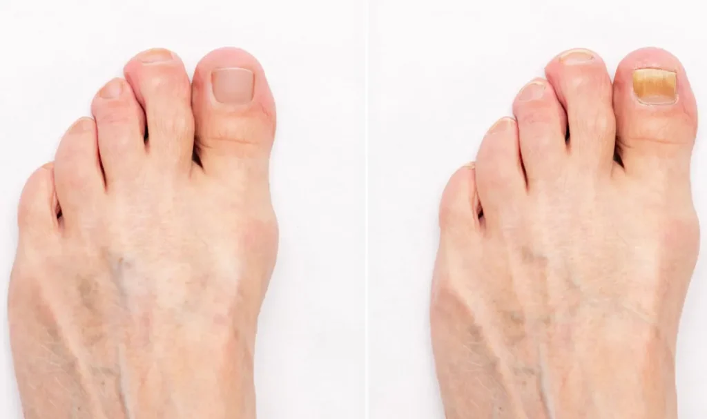 Laseroperationer för nagelsvamp