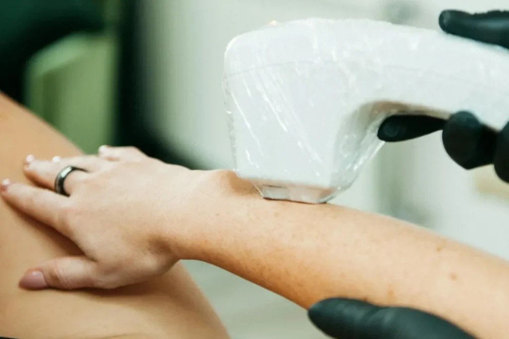 hyperpigmentering efter laserbehandling