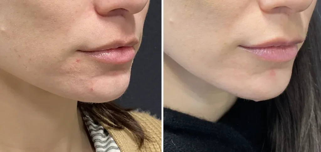 laserbehandling efter hormonella förändringar