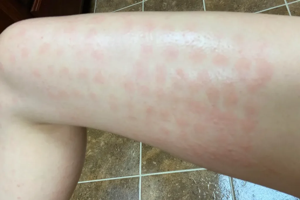 Otillfredsställande estetiska resultat efter laserbehandling