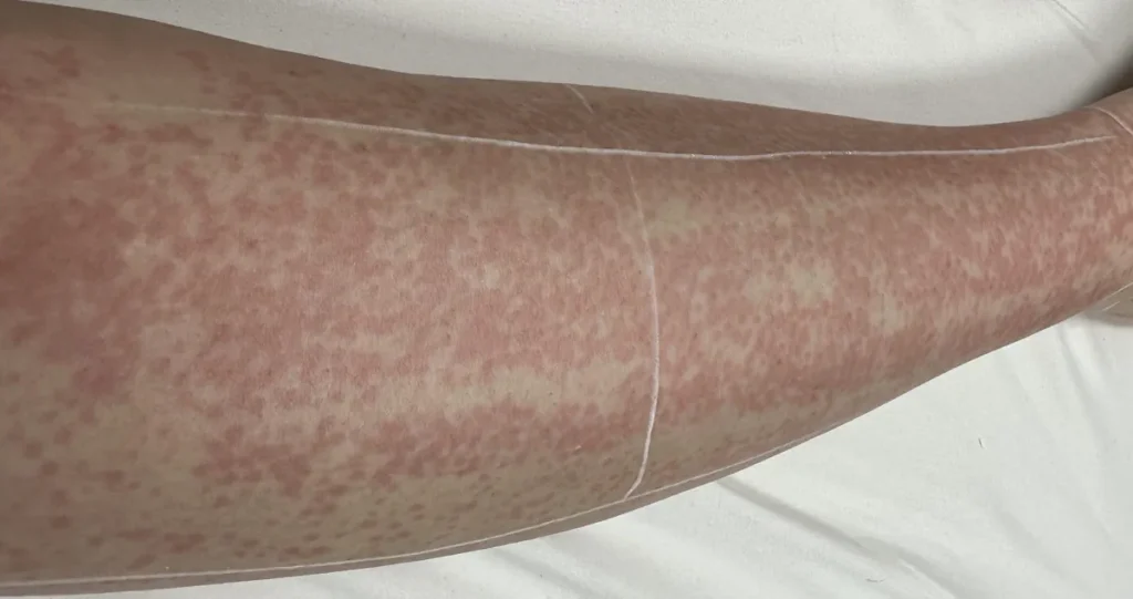 Allergiska reaktioner efter laserbehandling