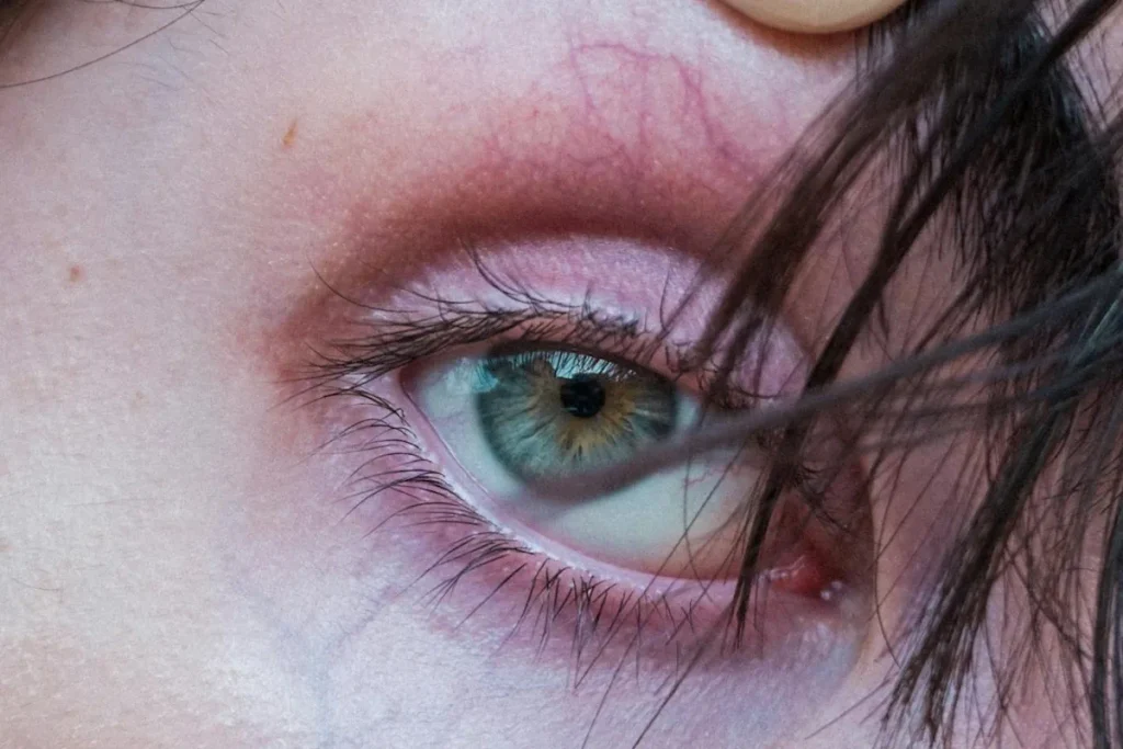 Synförlust efter laserbehandling