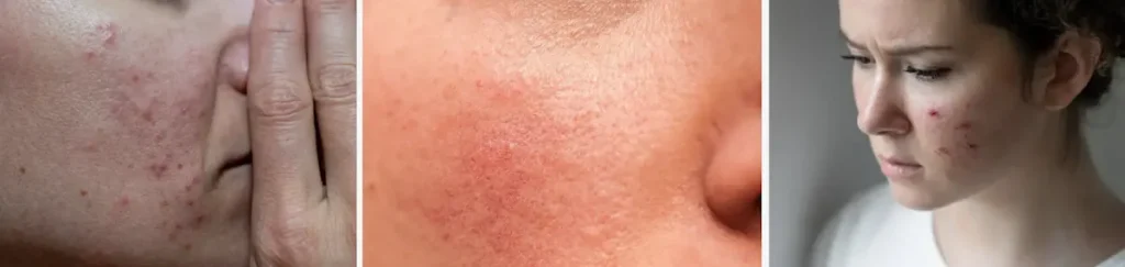 laserbehandling för rosacea
