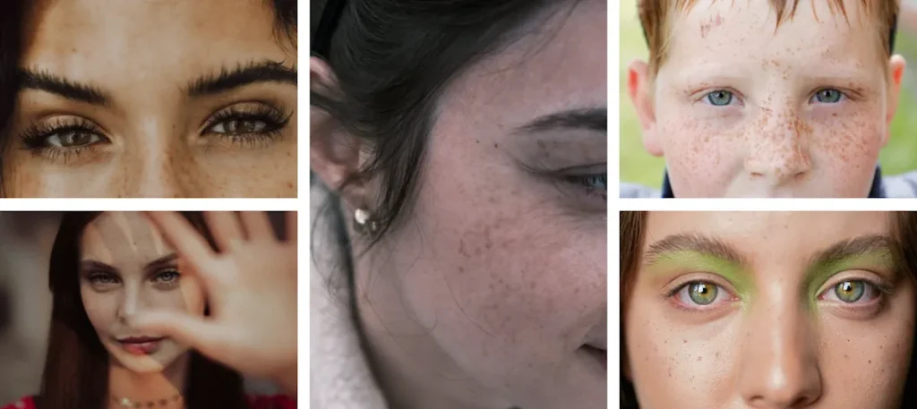 Laseroperationer för att minska pigmentfläckar