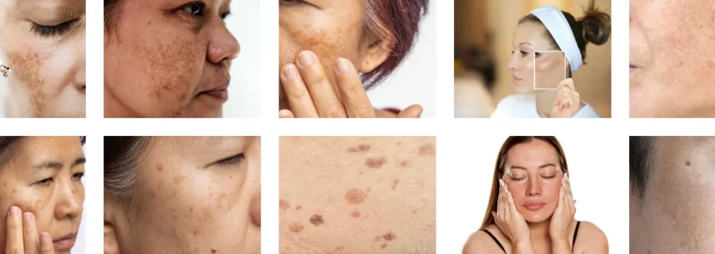 laser för att behandla melasma