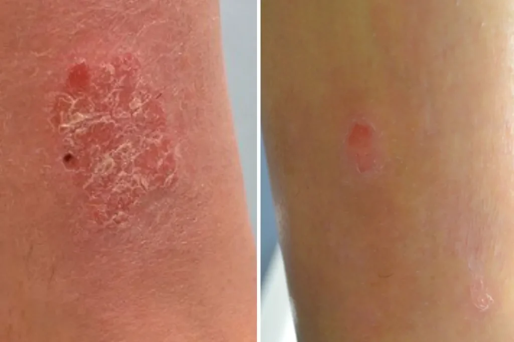 Laserbehandling för psoriasis