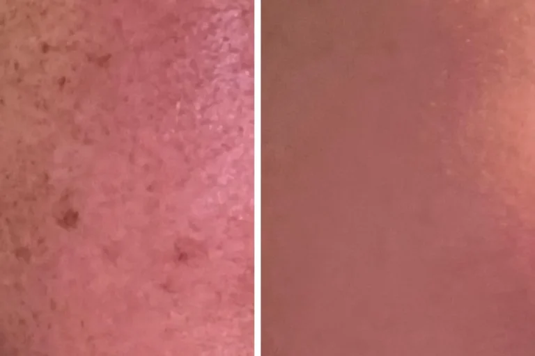 Laserbehandlingar för leverfläckar