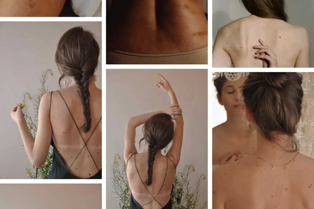 Laseroperationer för att ta bort födelsemärken