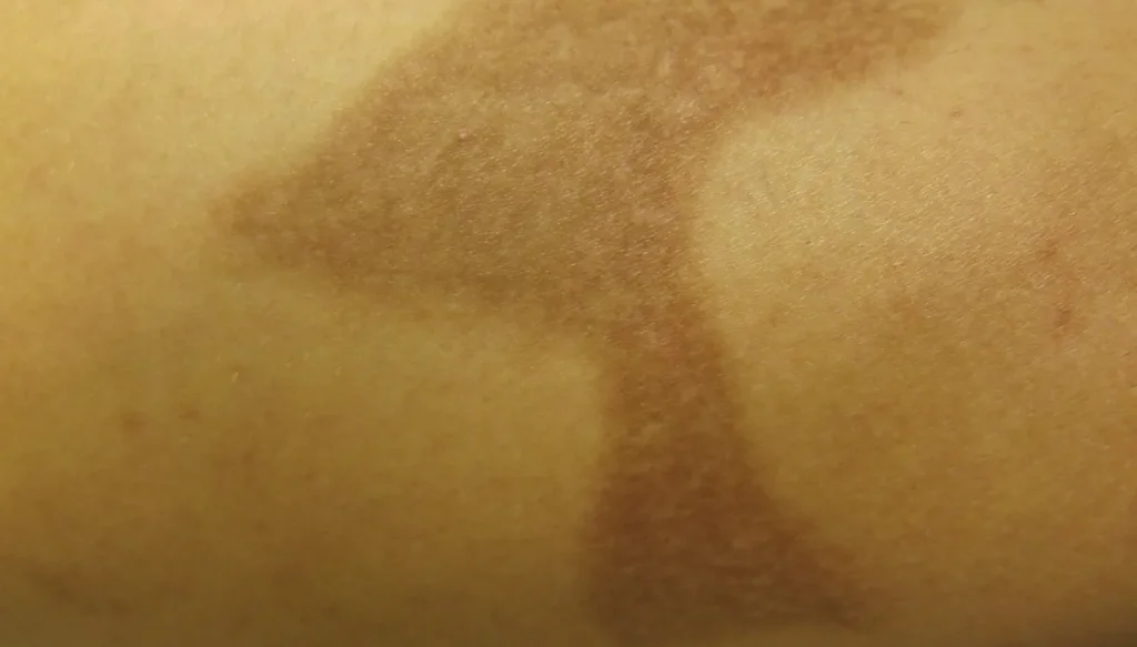 laser för att förbättra hudens utseende efter brännskador