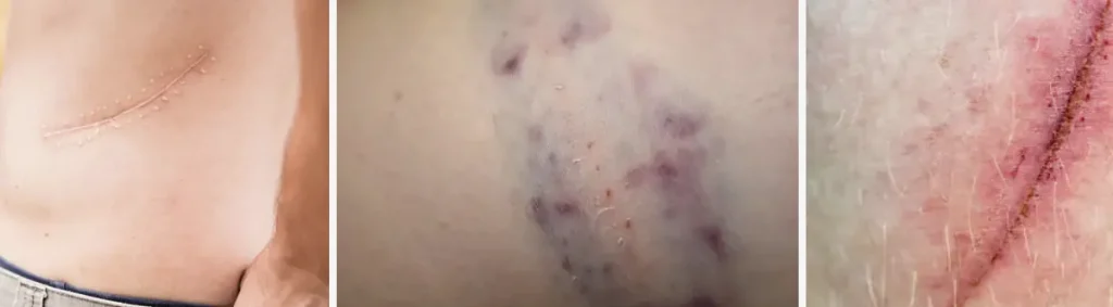 laser för att förbättra hudens utseende efter trauma