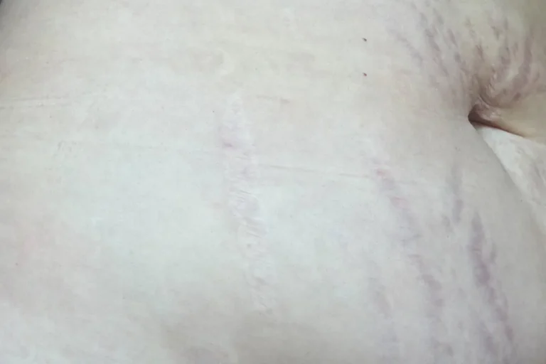 Laserbehandlingar för att förbättra hudens utseende efter viktminskning