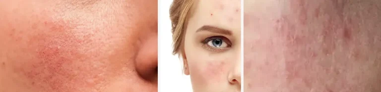 laserbehandling vid rosacea
