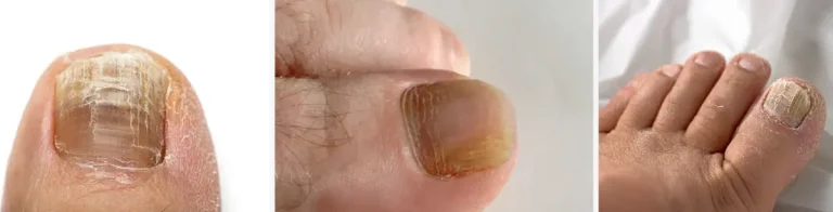 laserbehandling vid nagelsvamp