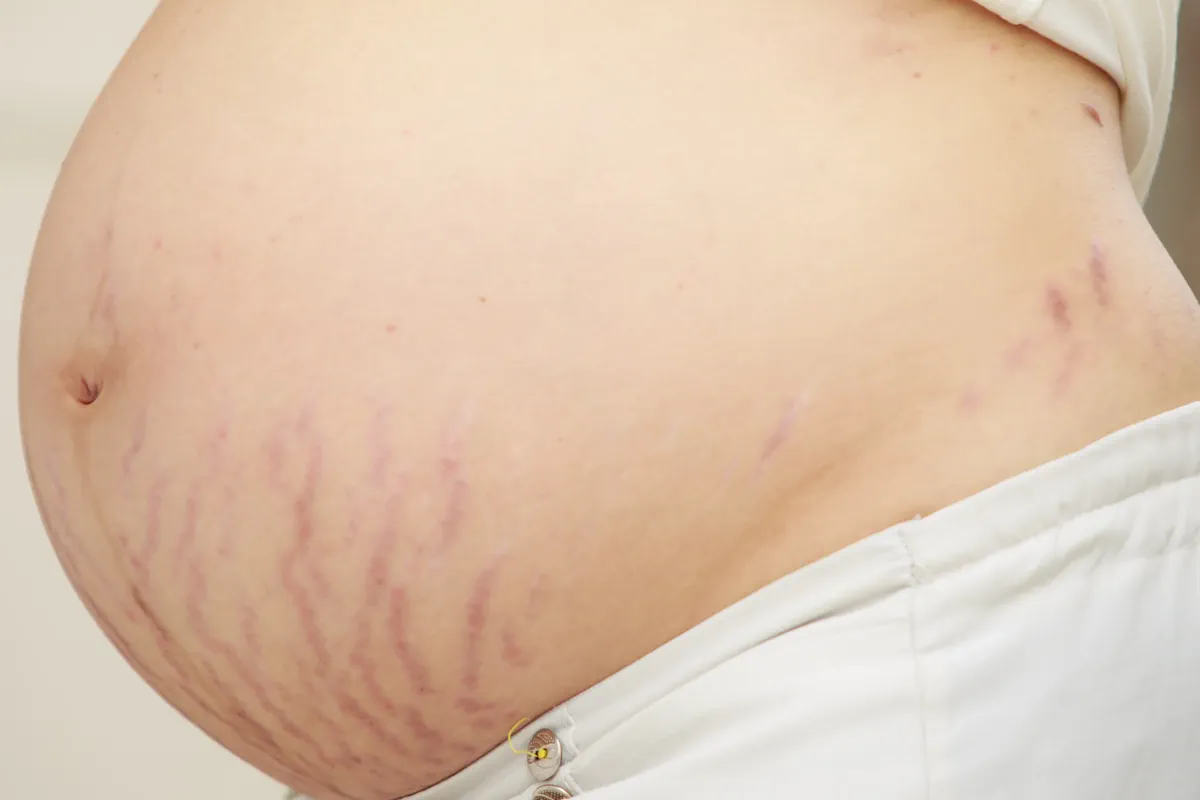 Laserbehandling efter graviditet