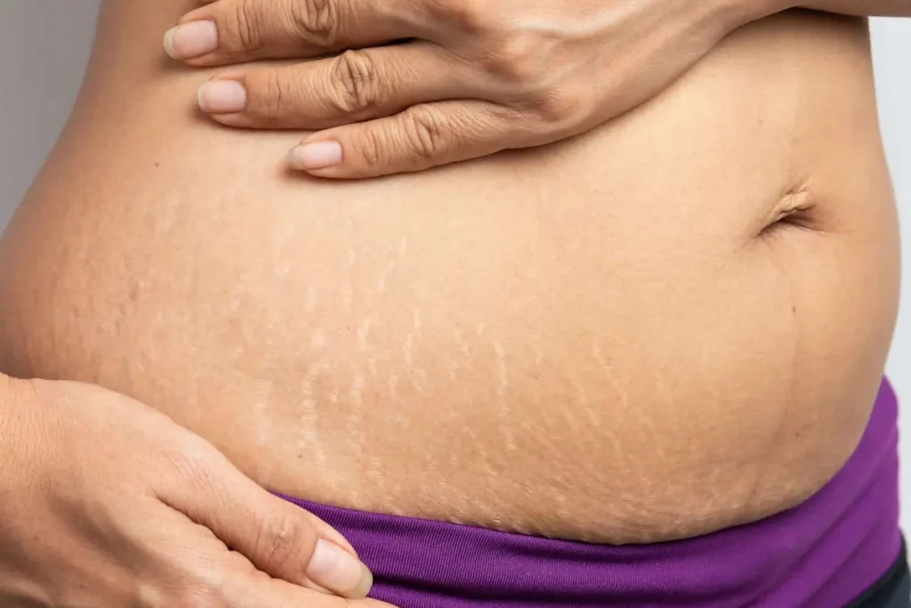 Laserbehandling efter viktminskning