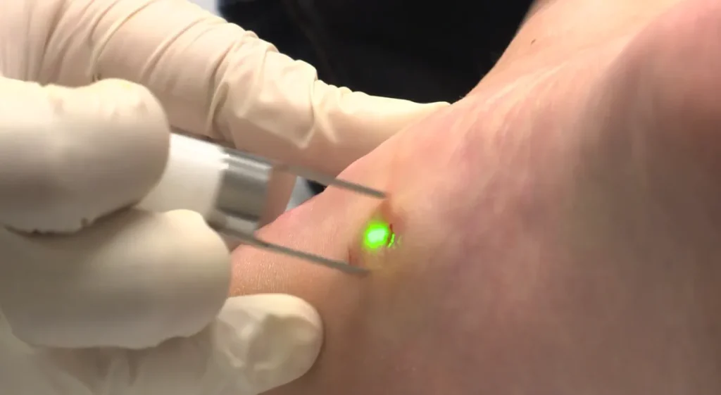 Laserborttagning av vårtor