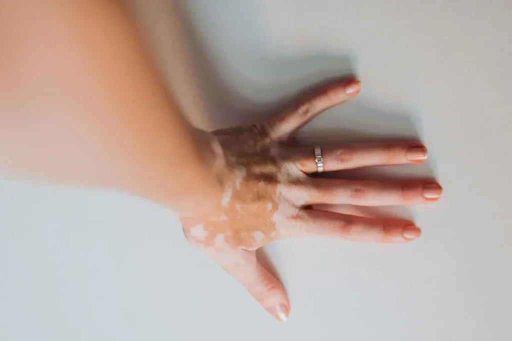 vitiligo