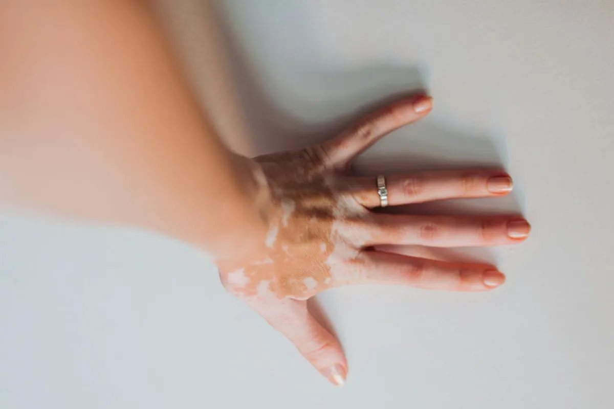vitiligo