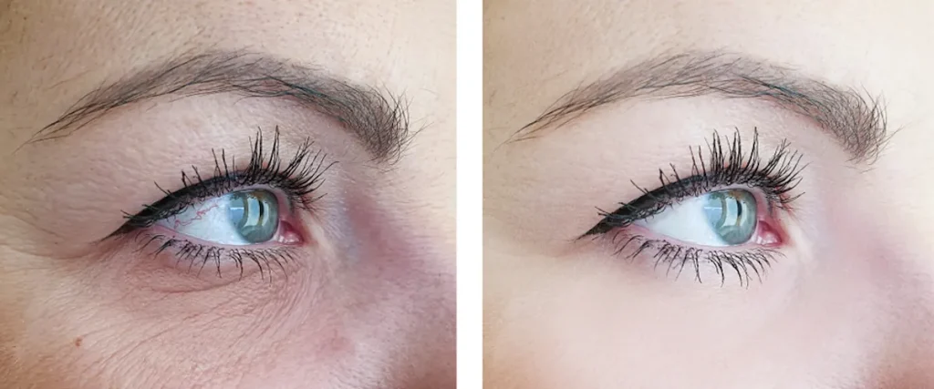 Laserbehandling för mörka ringar under ögonen