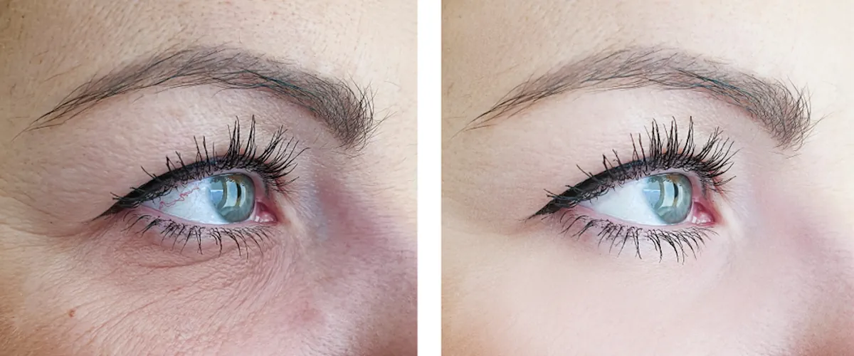 Laserbehandling för mörka ringar under ögonen