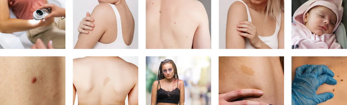 Laserborttagning av födelsemärken
