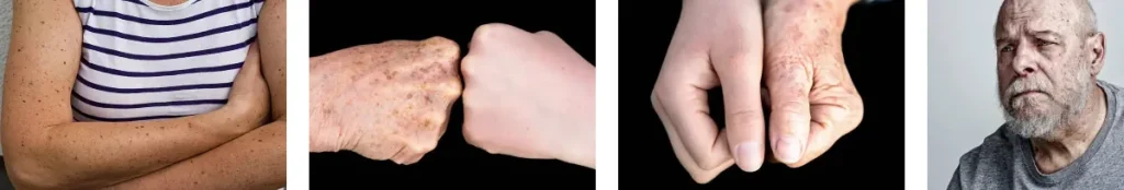 Laserborttagning av leverfläckar