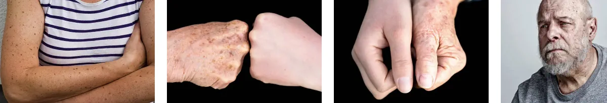 Laserborttagning av leverfläckar
