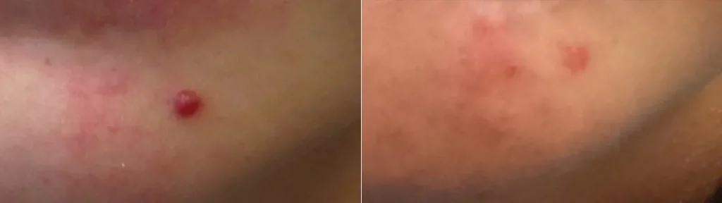 Laserbehandling för angiom (kärlknutor)