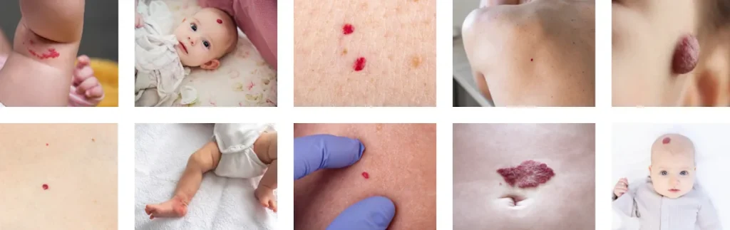 Laserbehandling för födelsemärken