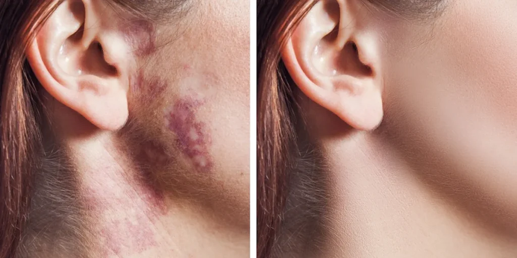 Laserbehandling för portvinsfläckar