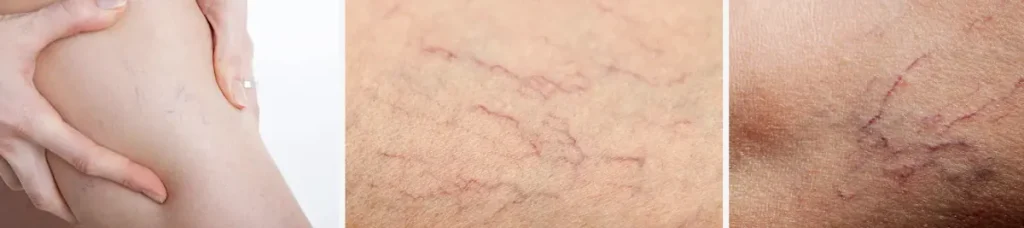 Laserbehandling för spindelvener