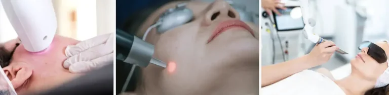Laserbehandling för hudförbättring efter psykologiska påfrestningar